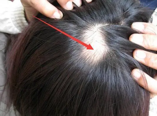 女子怕“秃头”3个月不洗头，后来发生了什么？